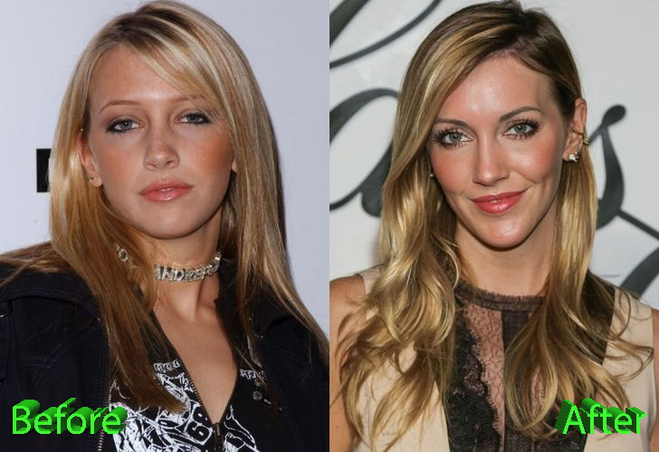 Katie Cassidy Before and After Cosmetic Surgery