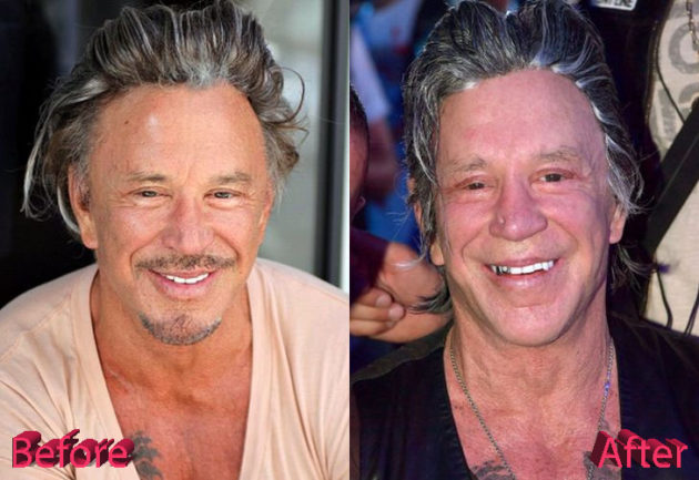 Mickey Rourke Plastic Surgery: Is It Enough?