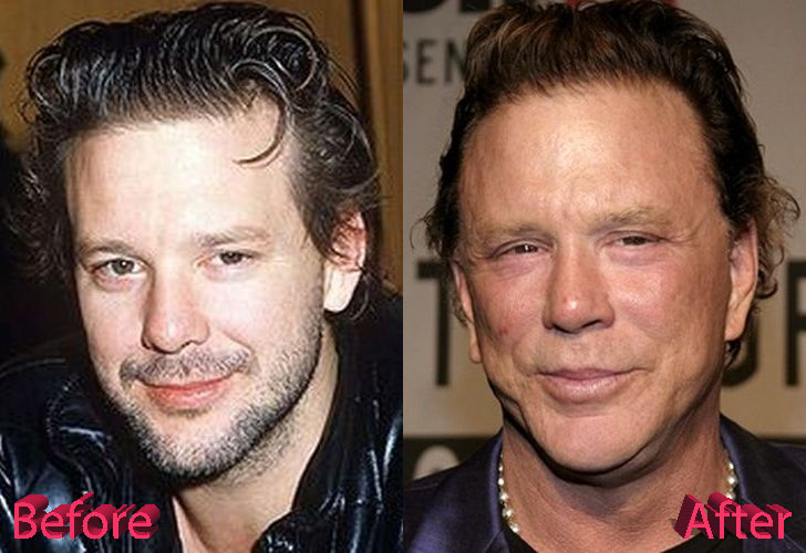 Mickey Rourke Plastic Surgery Before and After