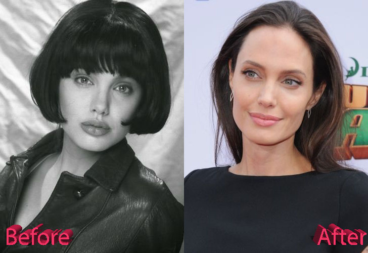 Angelina Jolie Before and After Cosmetic Surgery