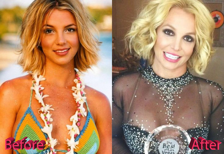 Britney Spears Before and After Cosmetic Surgery