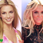 Britney Spears Before and After Surgery Procedure