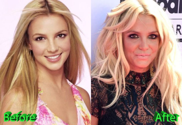 Britney Spears Plastic Surgery Few More Times