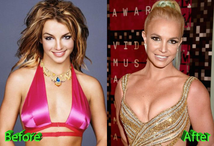Britney Spears Plastic Surgery Before and After