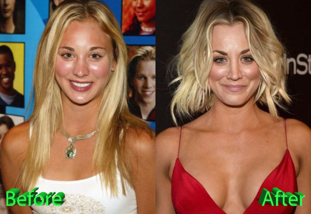 Kaley Cuoco Plastic Surgery An Example to Follow?