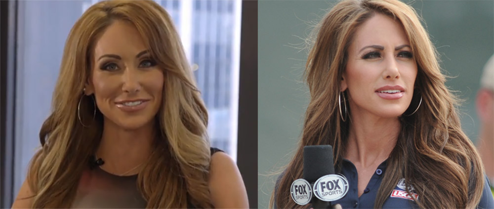 Holly Sonders before and after lip job plastic surgery