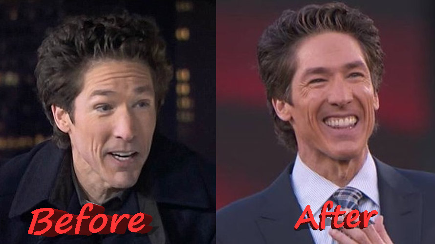 Joel Osteen Before and After Plastic Surgery