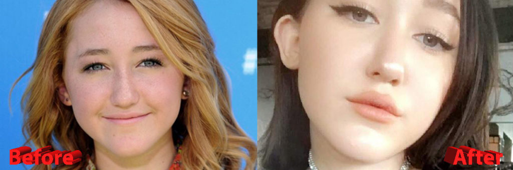 Noah Cyrus before and after lip implants.