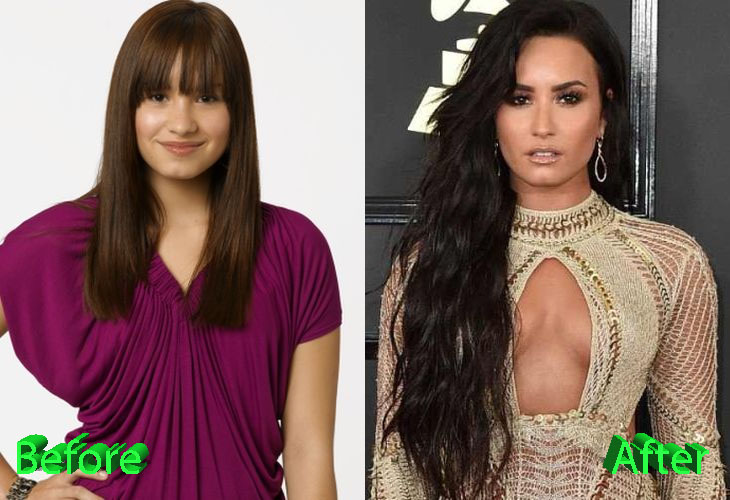 Demi Lovato Plastic Surgery: An Improvement For A Young Star