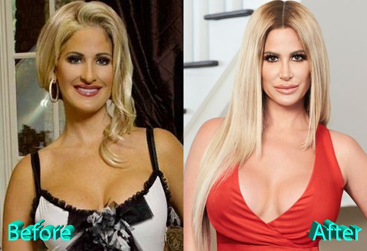 Kim Zolciak Before and After Multiple Surgery