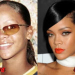 Rihanna Before and After Surgery Procedure