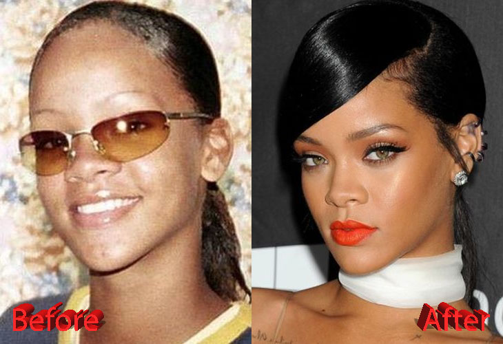Rihanna Before and After Surgery Procedure