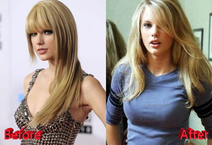 Taylor Swift Plastic Surgery Tell Us What Do You Think About Taylor Swift S Plastic Surgery