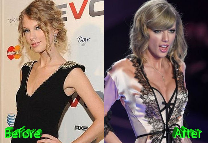 Taylor Swift Before and After Breast Implants