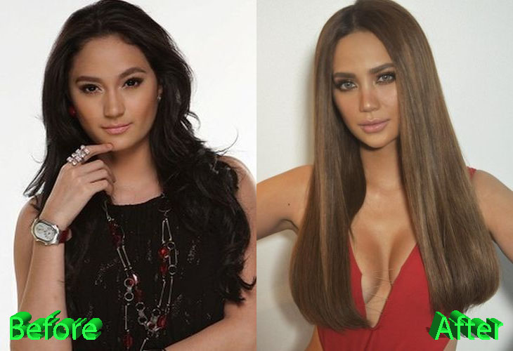 Arci Munoz Before and After Cosmetic Surgery