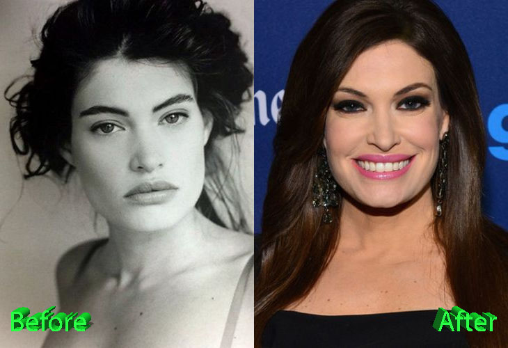 Kimberly Guilfoyle Before and After Plastic Surgery
