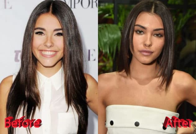 Madison Beer Plastic Surgery: Just Photoshop or the Real Thing?