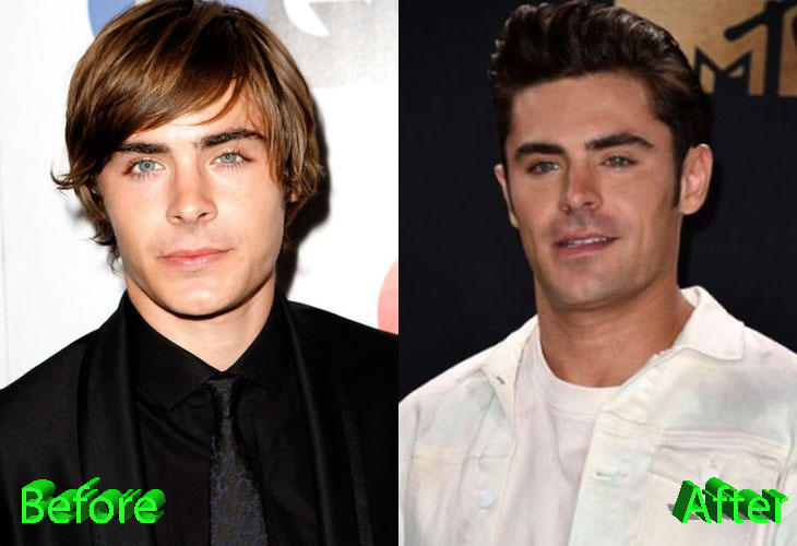 Zac Efron Plastic Surgery: A New Look For Teen Heartthrob