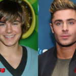 Zac Efron Before and After Plastic Surgery