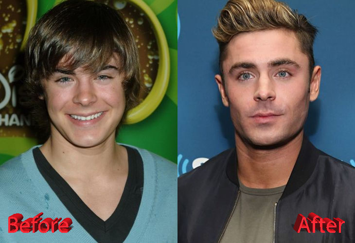 Zac Efron Before and After Plastic Surgery