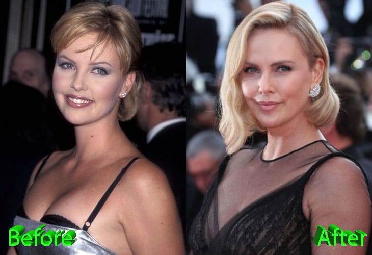 Charlize Theron Before and After Cosmetic Surgery
