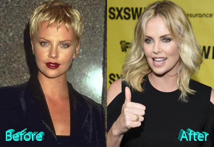 Charlize Theron Before and After Surgery Procedure