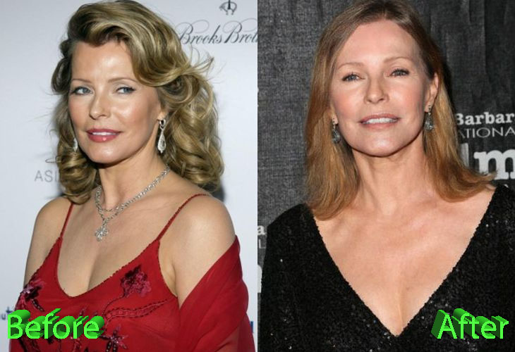 Cheryl Ladd Before and After Plastic Surgery.