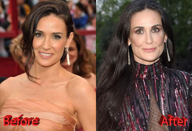 Demi Moore Before and After Plastic Surgery