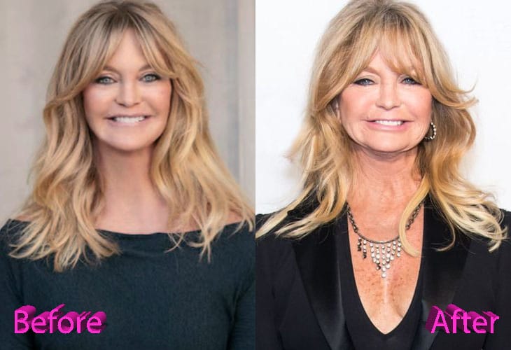 Goldie Hawn Before and After Plastic Surgery