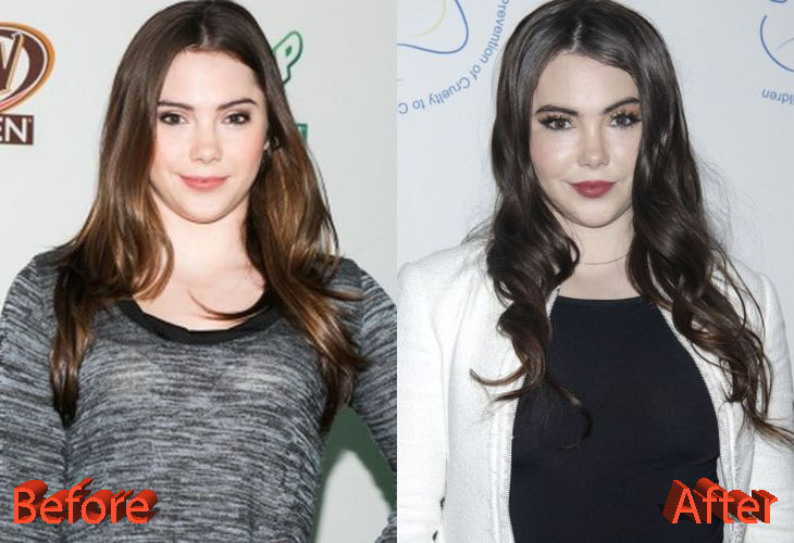 Mckayla Maroney Before and After Plastic Surgery