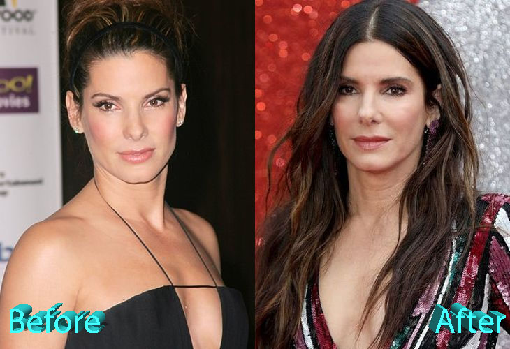 Sandra Bullock Before and After Cosmetic Surgery