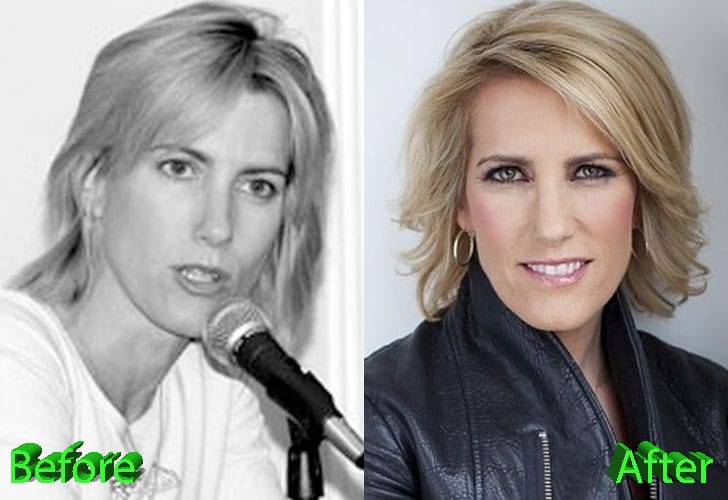 Laura Ingraham Before and After Surgery Procedure