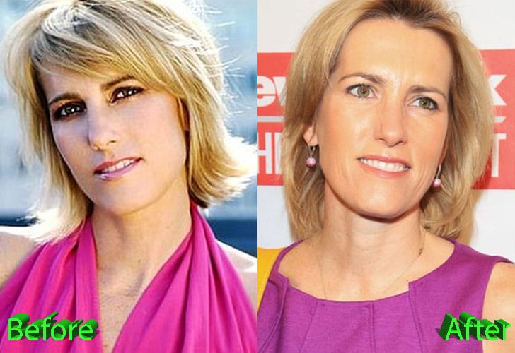 Laura Ingraham Plastic Surgery Nothing More Than A Gossip Celebrity   Laura Ingraham Plastic Surgery Before And After 