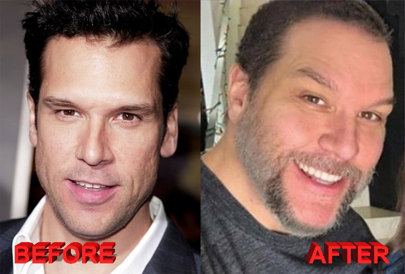 Dane Cook plastic surgery before and after